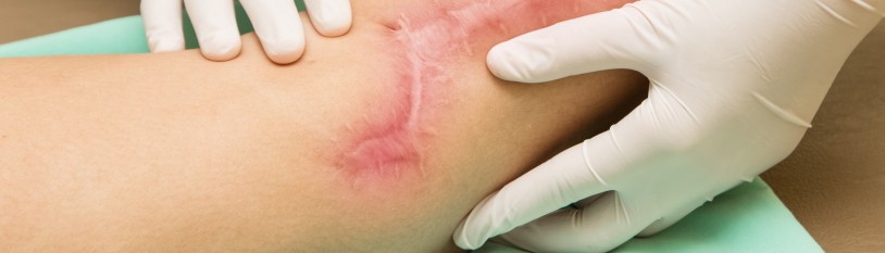 Scars and Disfigurement Attorney in Baltimore