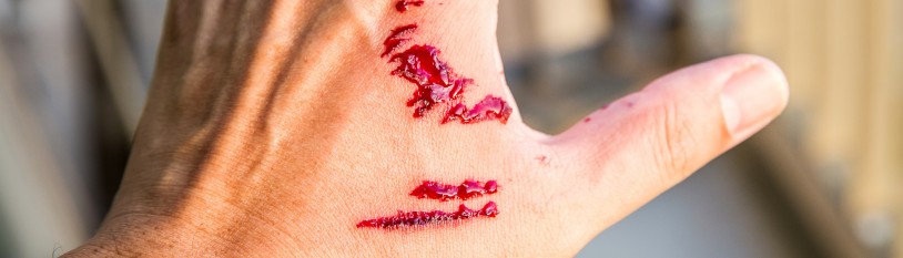 Dog Bite Lawyer in Baltimore